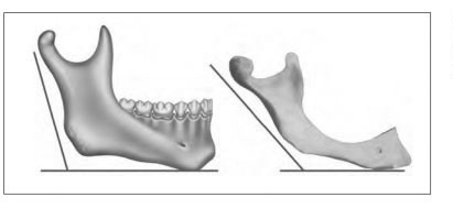 Mandible-Angle